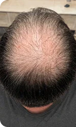 Antes